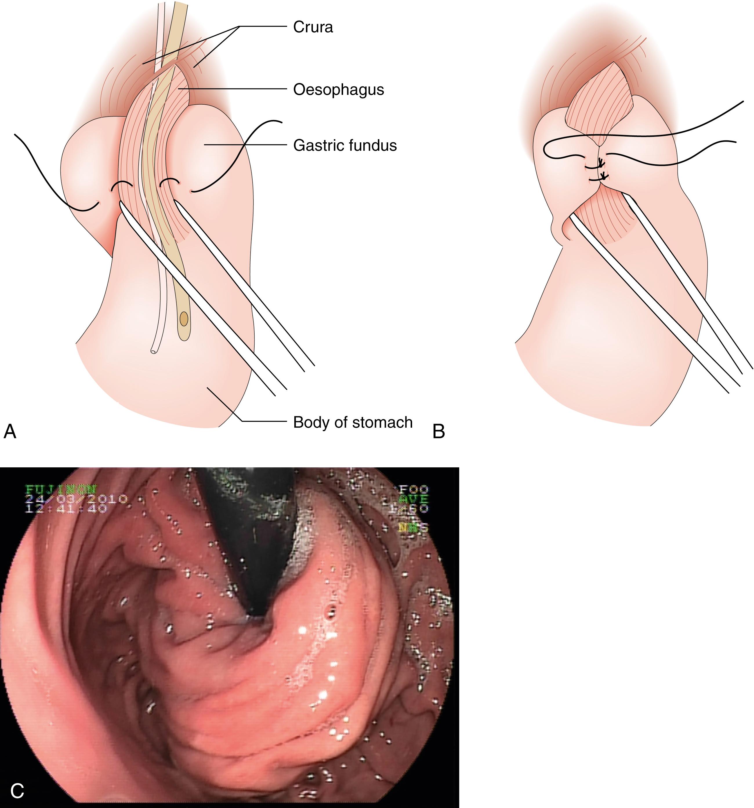 Fig. 14.13, Fundoplication for gastrooesophageal reflux disease.