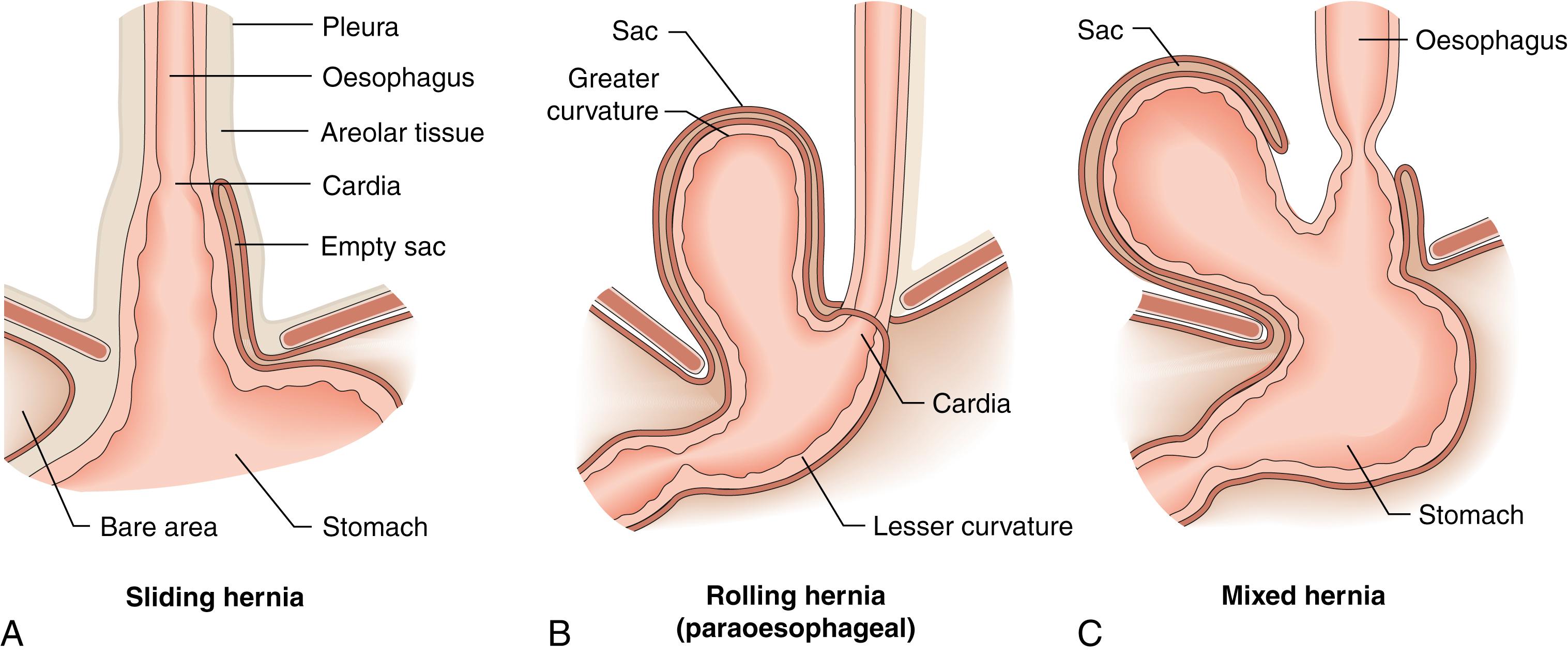 Fig. 14.14, Types of hiatus hernia.