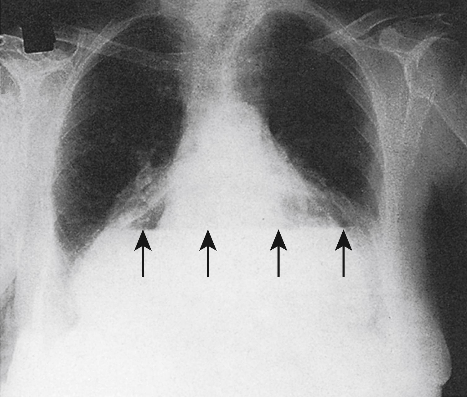 Fig. 14.3, Erect chest x-ray showing an intrathoracic stomach secondary to a giant hiatus hernia. Note the air–fluid level.