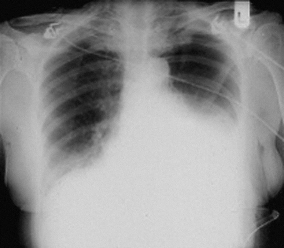 Fig. 14.4, Erect chest x-ray showing left hydropneumothorax in a patient with Boerhaave syndrome.