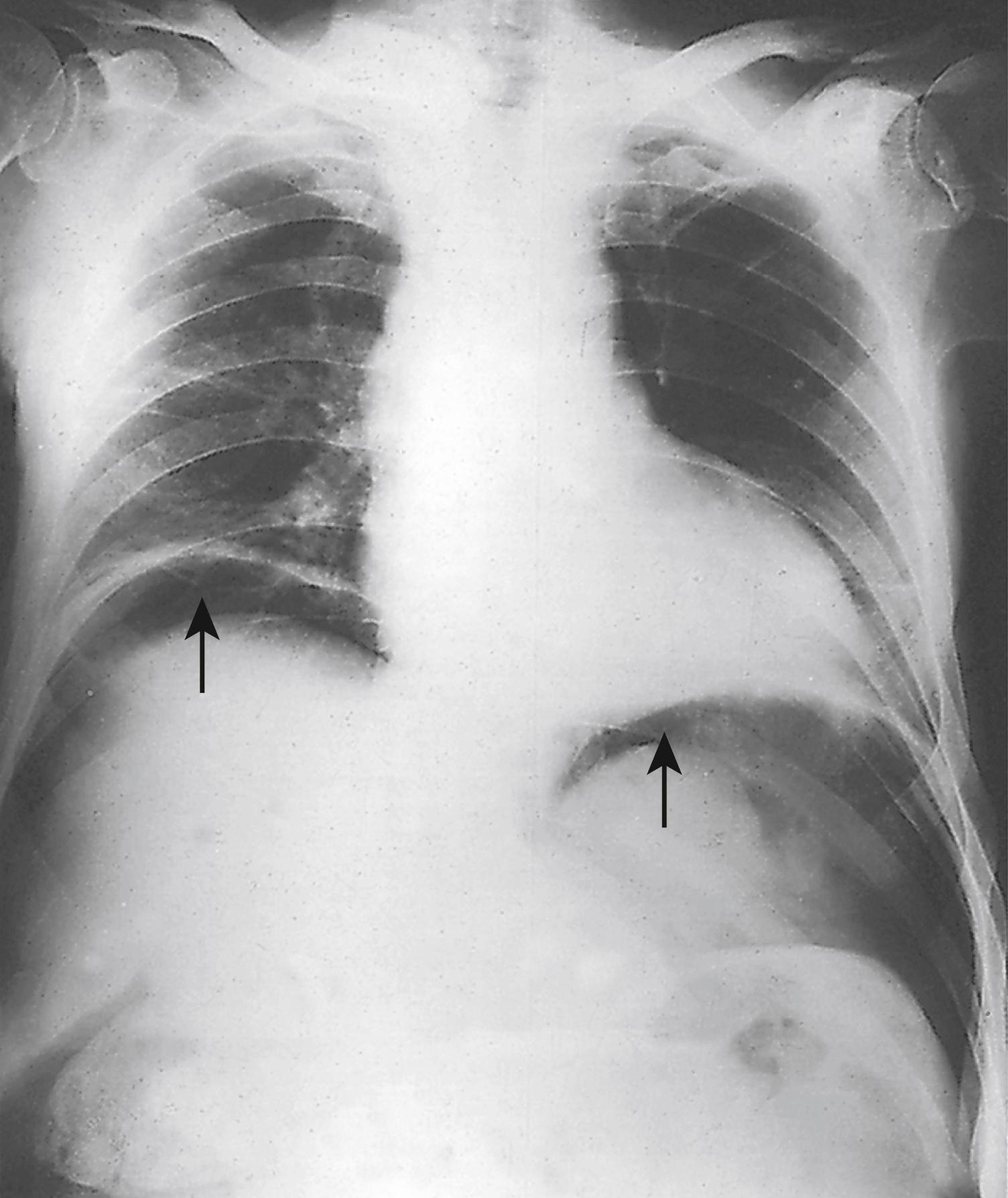 Fig. 14.5, Erect chest x-ray showing free air under both hemidiaphragms secondary to a perforated duodenal ulcer.