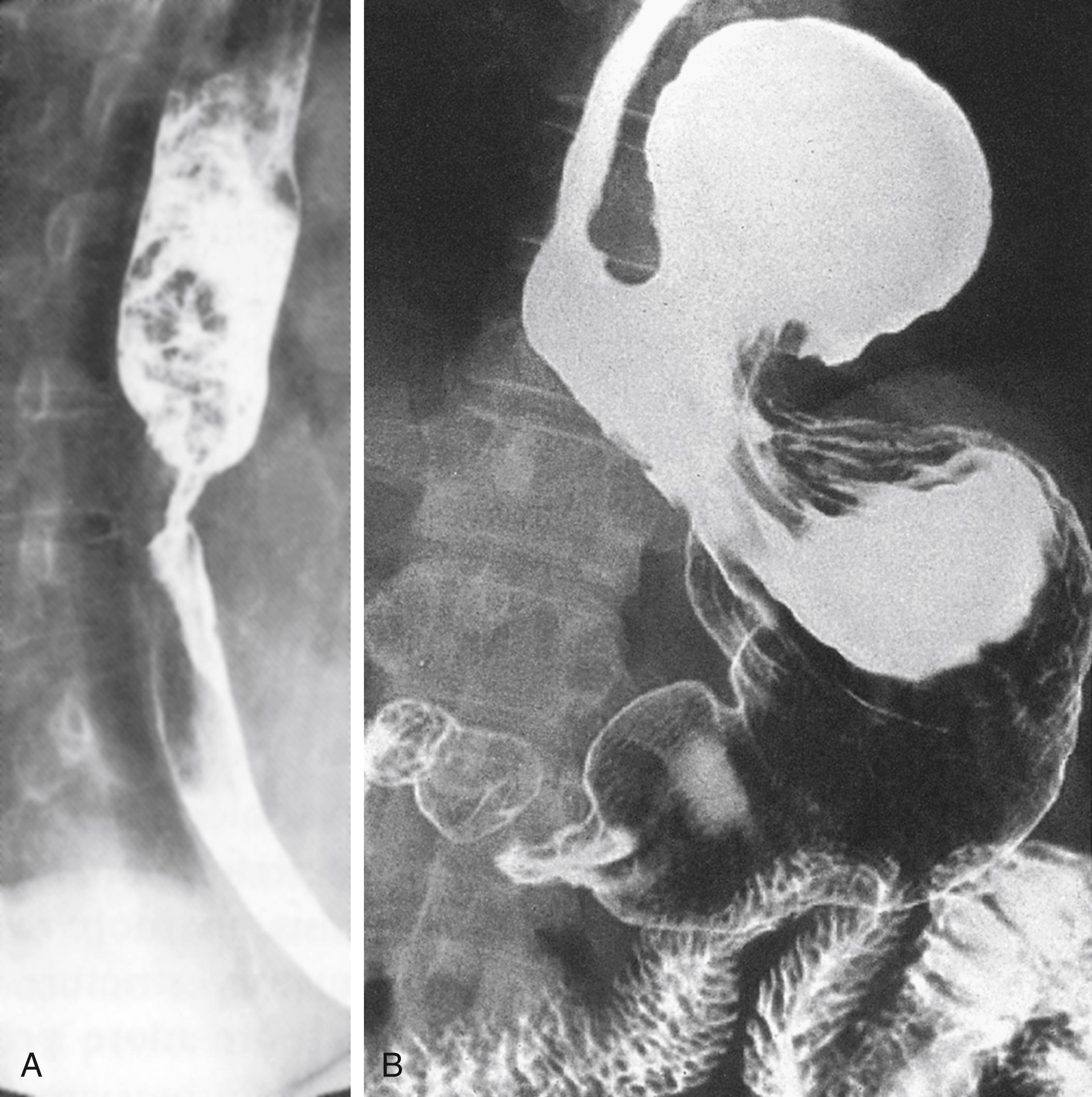 Fig. 14.7, (A) Barium swallow showing a malignant-looking stricture of the midoesophagus. (B) Barium meal showing a large paraoesophageal hiatus hernia.