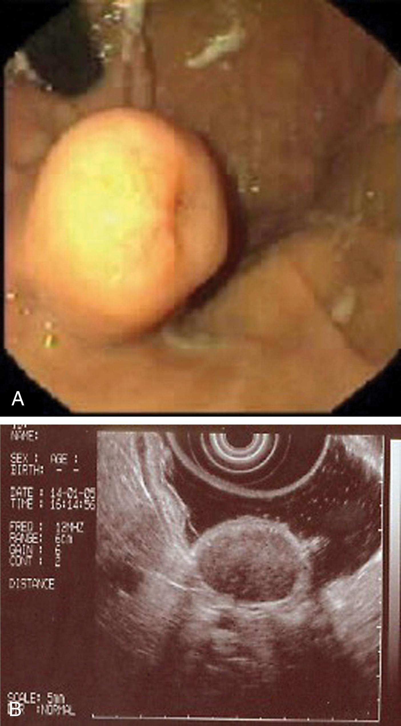 Fig. 14.9, (A) Endoscopic view of a 2-cm diameter polypoid submucosal gastric lesion. (B) EUS confirms the lesion is arising from the muscularis propria and likely to be a gastrointestinal stromal tumour.