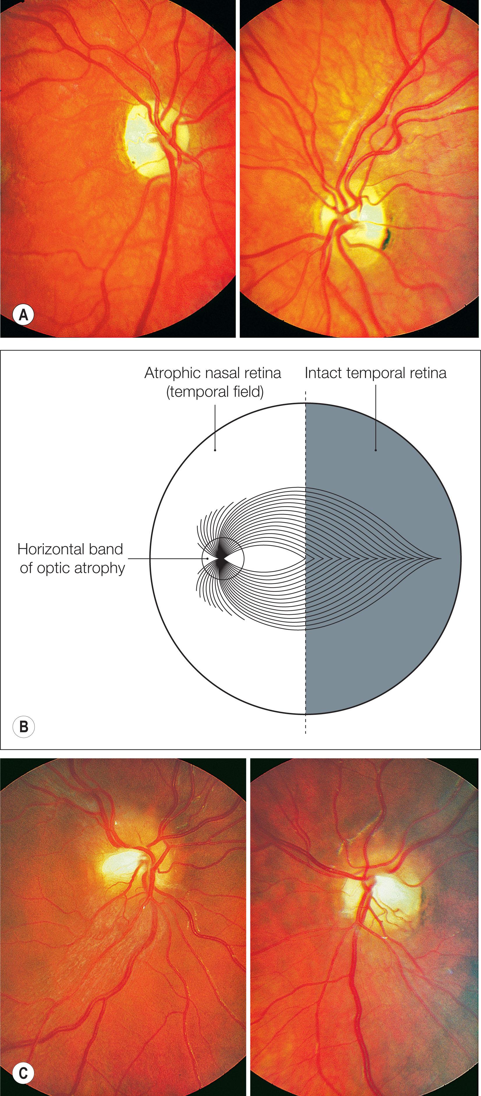 Fig. 57.3, Craniopharyngioma. (A) The right eye has bare perception of hand movements. The left eye has an absolute temporal hemianopia, normal color vision, and a visual acuity of −0.1 LogMAR (6/4.8, 20/16, 1.25). The left optic disc shows band atrophy: there is loss of the nerve fibers that subserve the temporal visual field but preservation of those that subserve the nasal field, which are inserted into the upper and lower segments of the disc. (B) The origin of the band of atrophy is due to the fact that the horizontal band or bow-tie area is the visible area of atrophy where temporal field fibers alone are inserted into the disc. (C) Craniopharyngioma showing “bi-lobed” papilledema during a period of raised intracranial pressure. Since papilledema occurs only when the retinal ganglion cell axons are swollen and only the superior and inferior (nasal field) axons survive in chiasmal compression, the papilledema occurs only in the upper and lower poles giving bi-lobed or “twin peaks” papilledema.