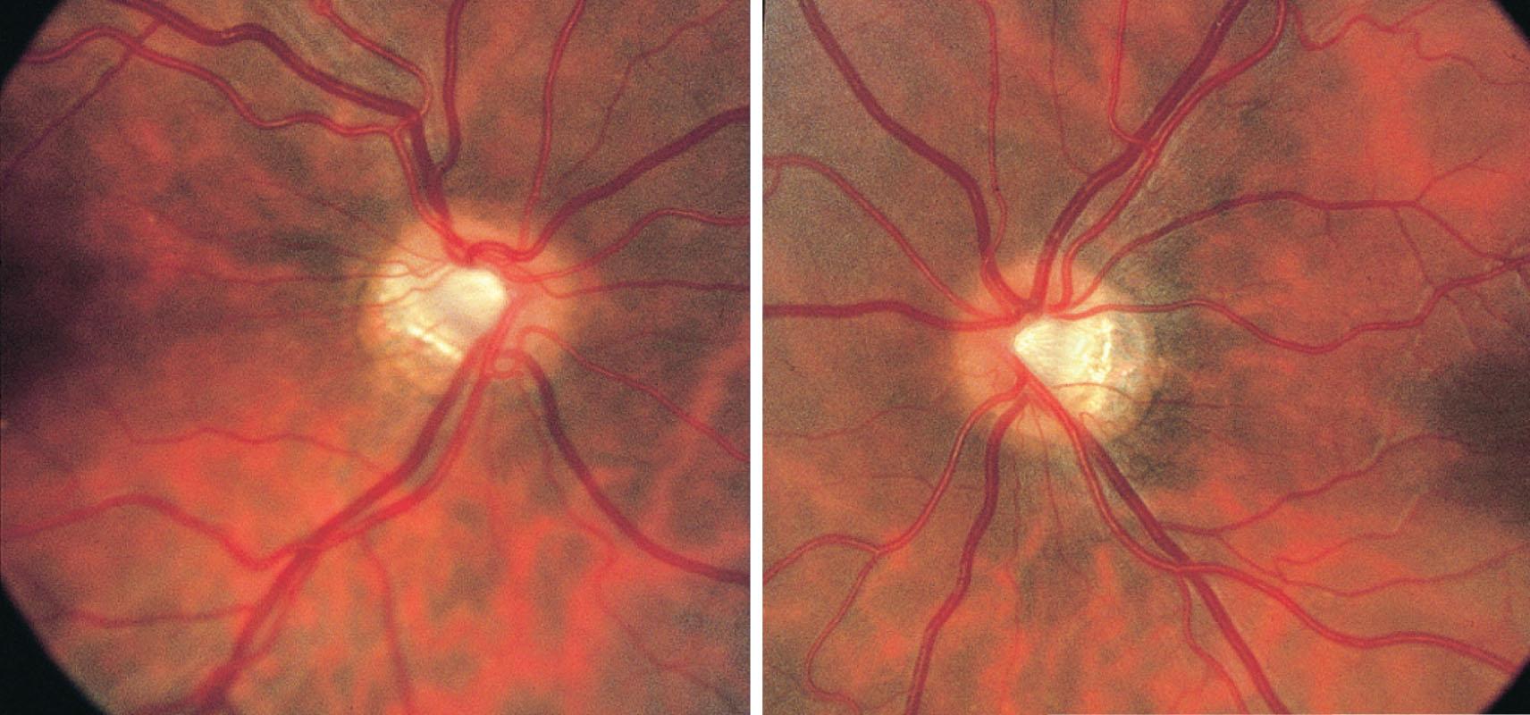 Fig. 57.4, Craniopharyngioma. Bilateral segmental hypoplasia or “tilted” optic disc. Bitemporal hemianopia with a visual acuity of −0.1 LogMAR (6/4.8, 20/16, 1.25) right eye (refraction: −4.0 D) and −0.22 (6/3.6. 20/12, 1.67) left eye (−4.50 D).