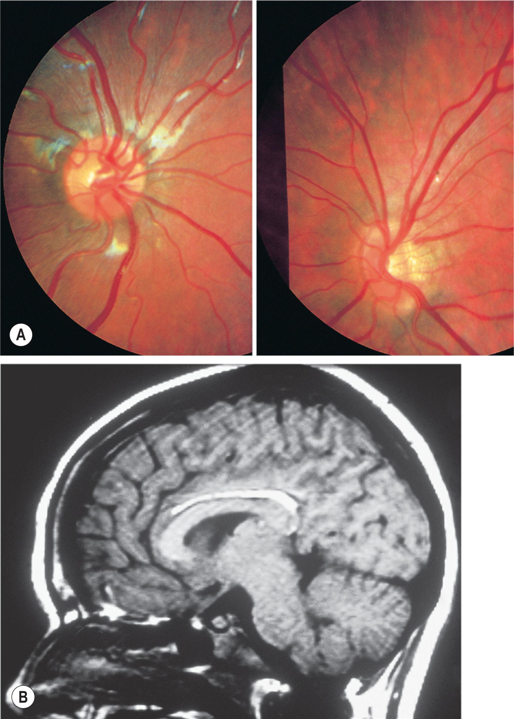 Fig. 57.5, Midline facial defect. (A) Dysplastic tilted left optic disc in a patient with a midline facial defect. (B) Magnetic resonance imaging of corpus callosum lipoma in a patient with a midline facial defect.