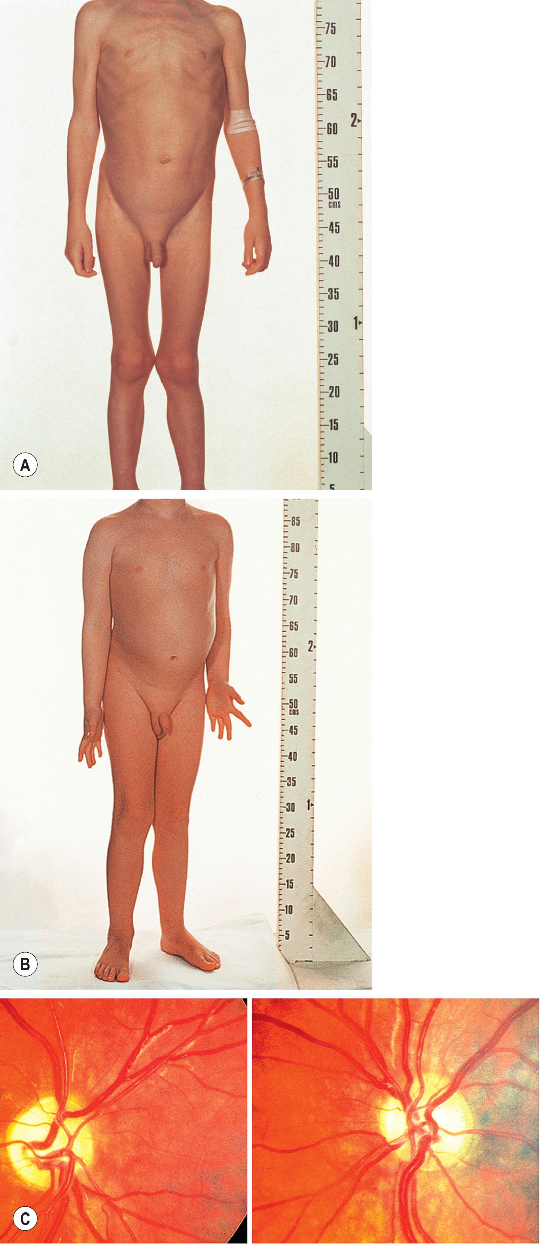 Fig. 57.6, Chiasmal glioma. (A) This boy presented with poor vision and recent weight loss – photograph on 12 February 1973. (B) Photograph on 31 January 1974 showing rapid growth in weight and height. Weight and growth rate fluctuation are common in chiasmal glioma. (C) Bilateral band atrophy (same patient).