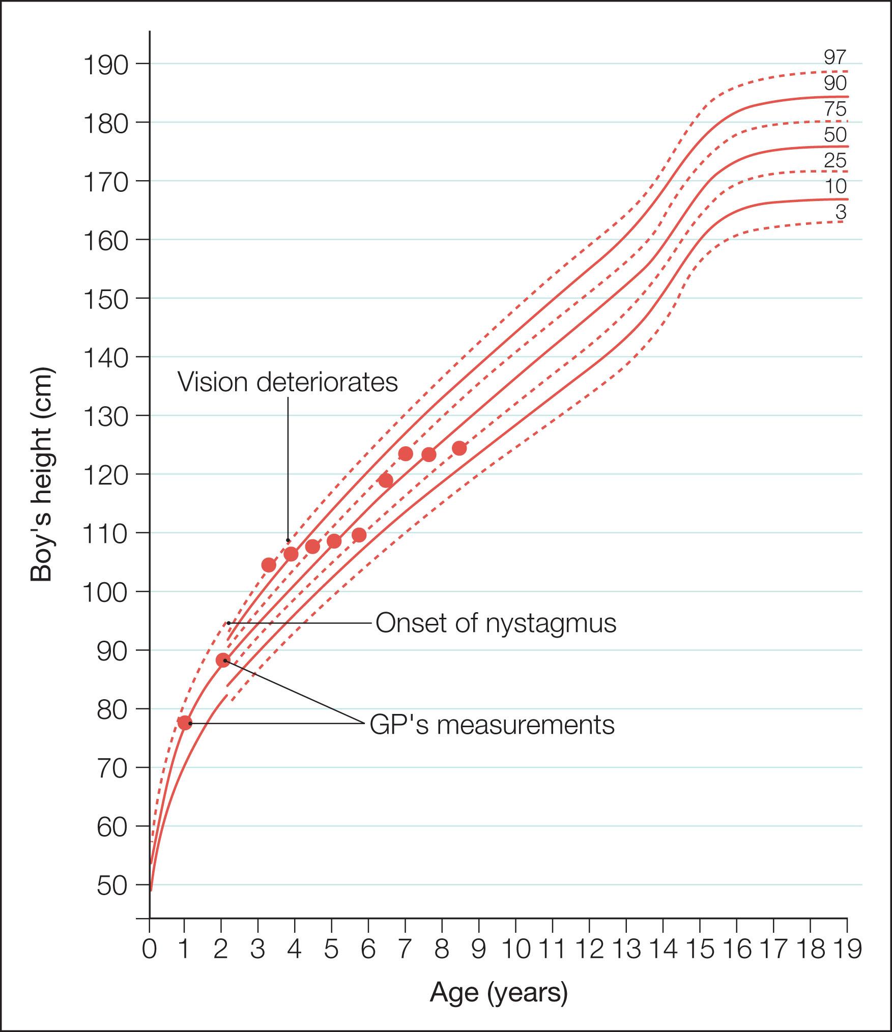 Fig. 57.7, Height growth record of a child with chiasmal glioma showing height growth rate fluctuation. Pediatric ophthalmology clinics need to have these charts available.