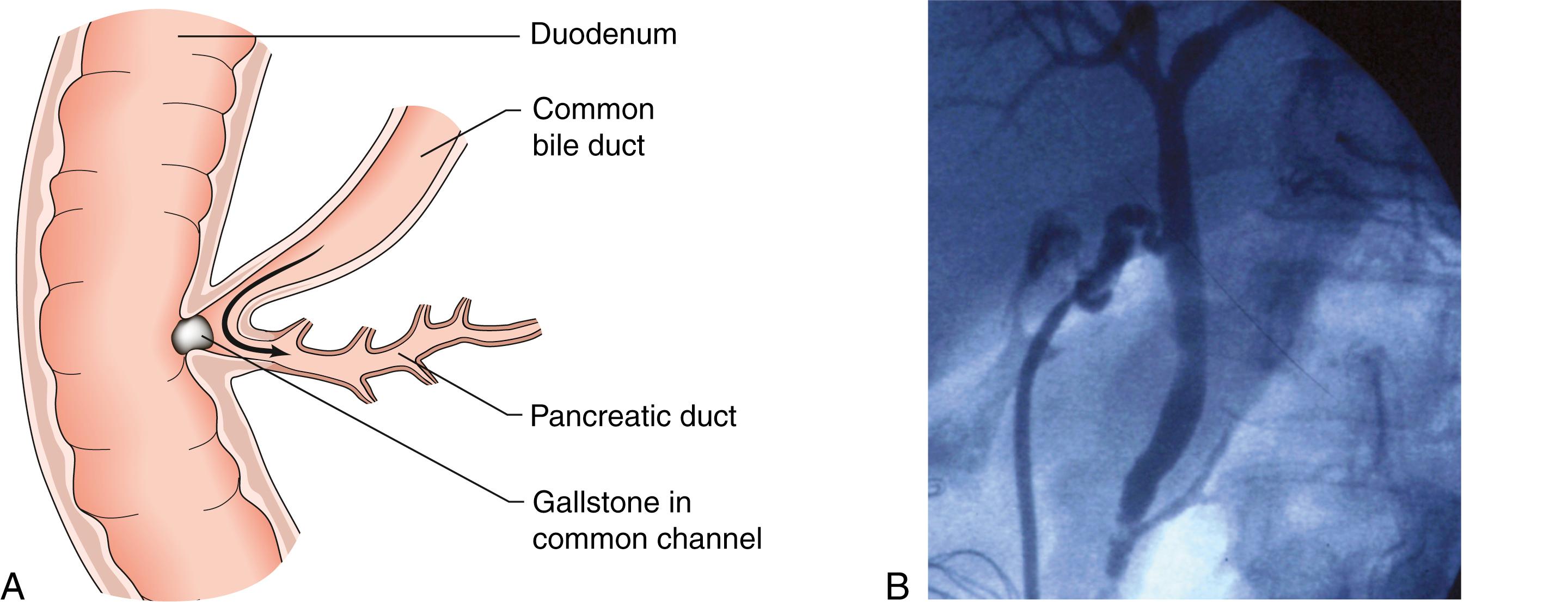 Fig. 16.3, (A) Common channel shared by the bile duct and the pancreatic duct may allow gallstone pancreatitis. (B) Operative cholangiogram showing a stone in the distal common bile duct and reflux of contrast into the pancreatic duct.