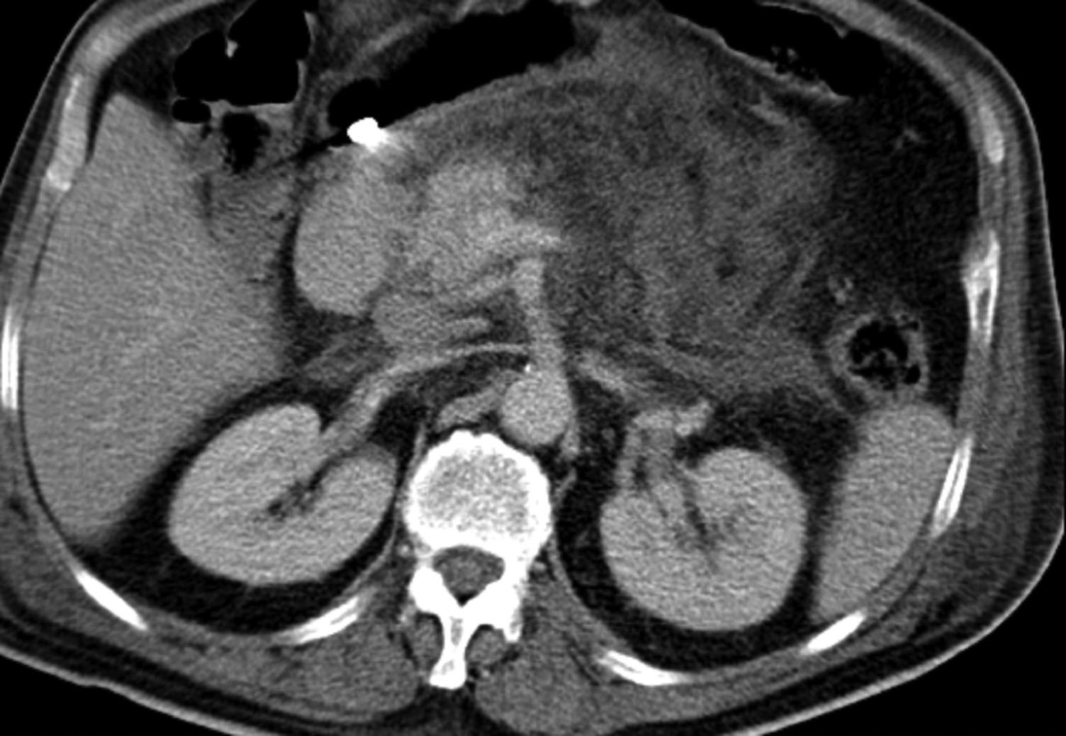 Fig. 16.4, Early computed tomography (CT) with oedema and tail necrosis.