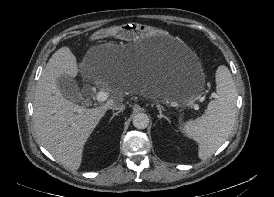 Fig. 16.5, Axial computed tomography (CT) with a large retrogastric postacute inflammatory collection approximately 8 weeks after initial presentation.