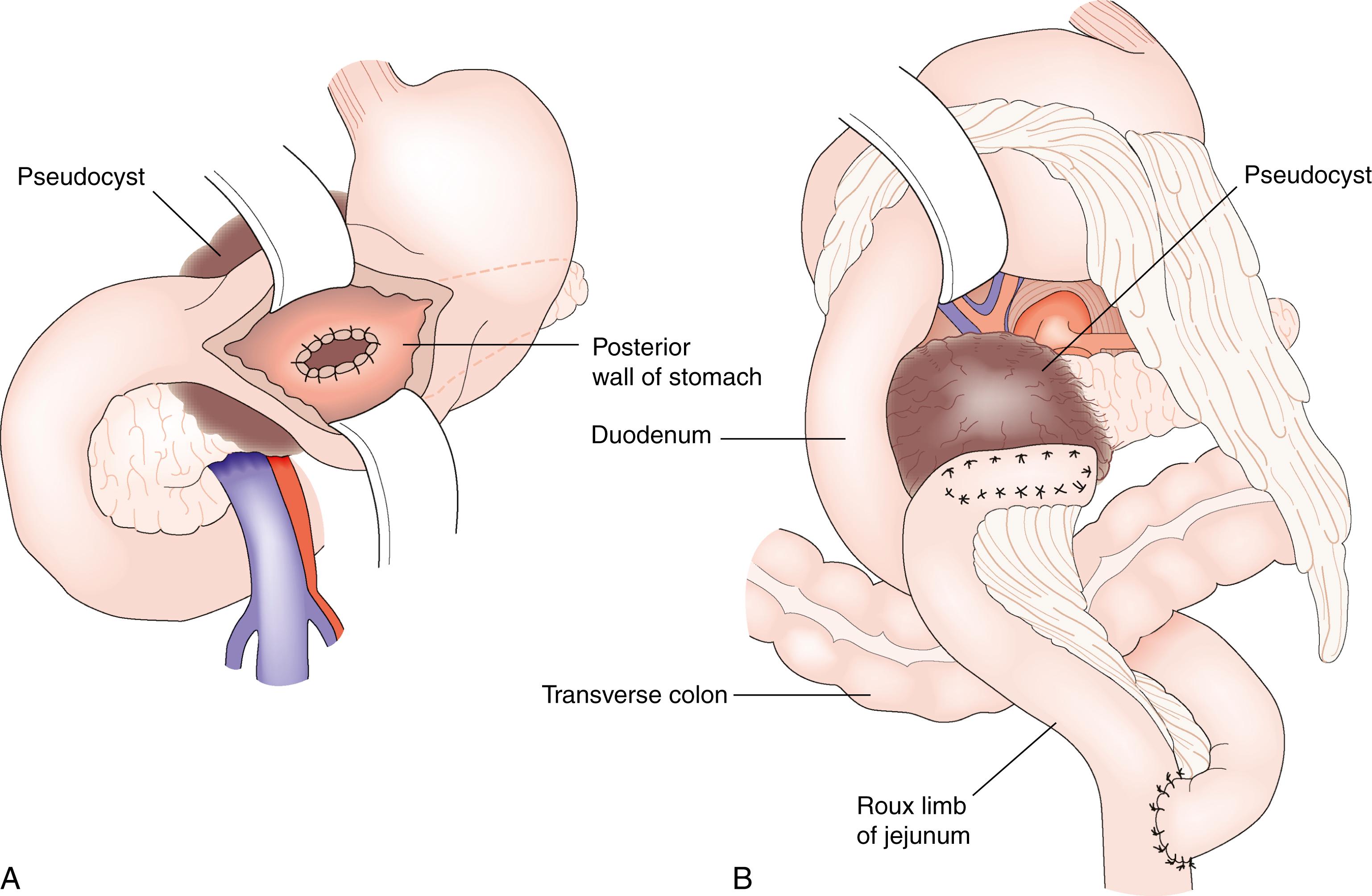 Fig. 16.6, Treatment of pancreatic pseudocyst. (A) Transgastric cyst gastrostomy. (B) Roux cyst jejunostomy.