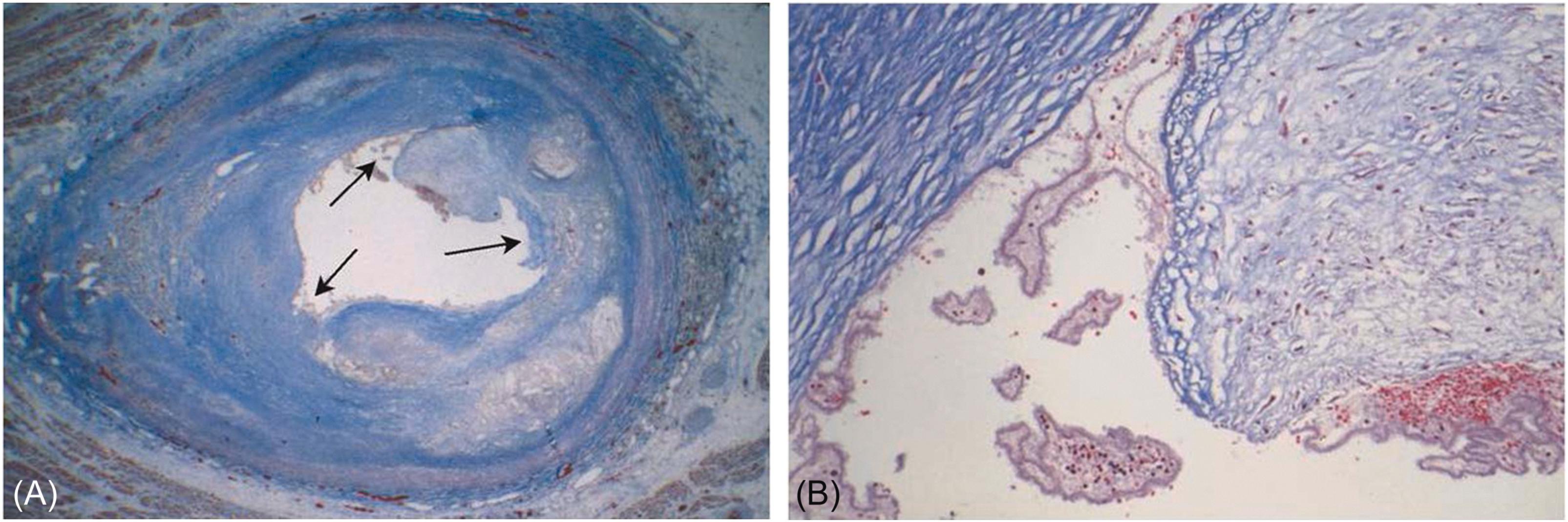 Figure 18.1, Coronary artery after percutaneous transluminal angioplasty (PTCA). (A) ( Left panel ) There are areas of plaque disruption ( arrows ) with microthrombus on the surface. (B) ( Right panel ) Close-up view of the fissured surface of the plaque with attached microthrombus (Trichrome stains).