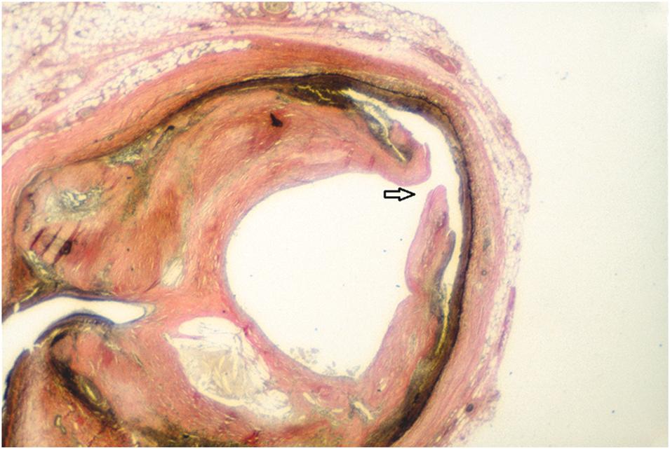 Figure 18.2, Plaque fracture encompassing intima and media ( arrow ) and partial circumferential wall dissection induced by percutaneous coronary balloon angioplasty (PTCA). These features account for both the efficacy and potential complications of PTCA (Elastin stain) [20, p. 75] .