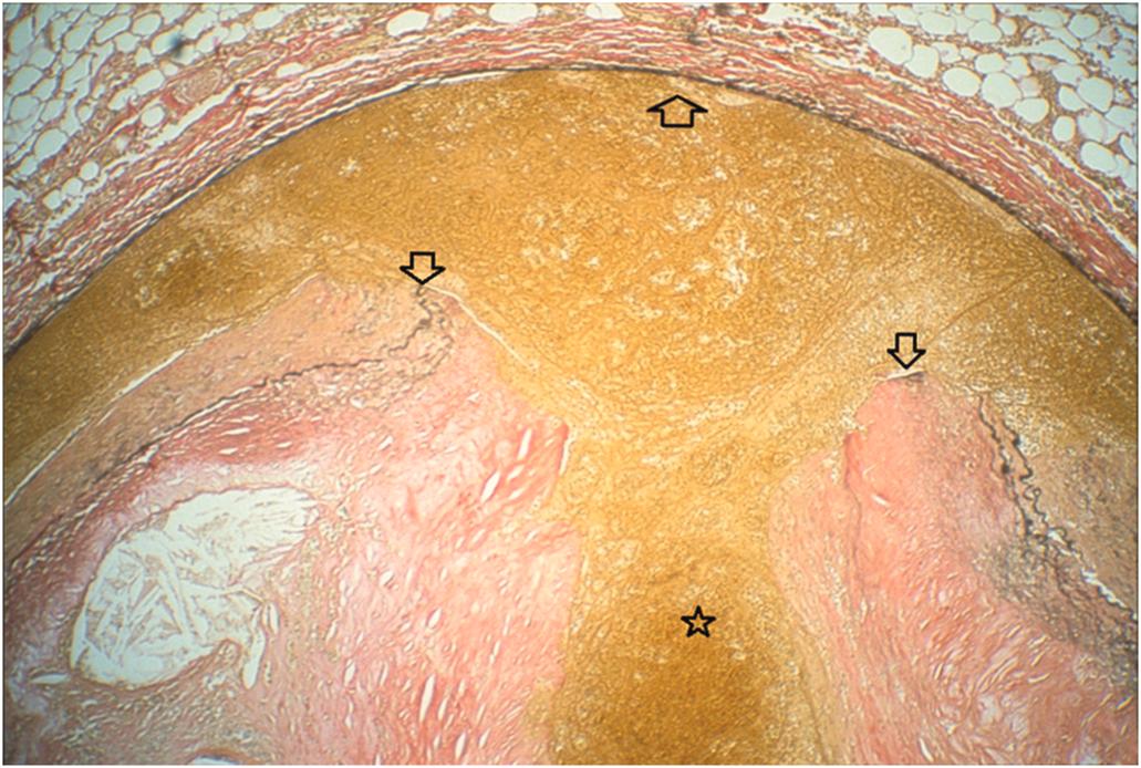 Figure 18.4, Coronary lesion following angioplasty, demonstrating a plaque fracture region. New surfaces ( arrows ) have been generated by the process of angioplasty. They are highly thrombogenic and, indeed, have initiated early thrombosis in this case that involves both the original lumen ( asterisk ) and the new space created by the medial dissection (Elastin stain).