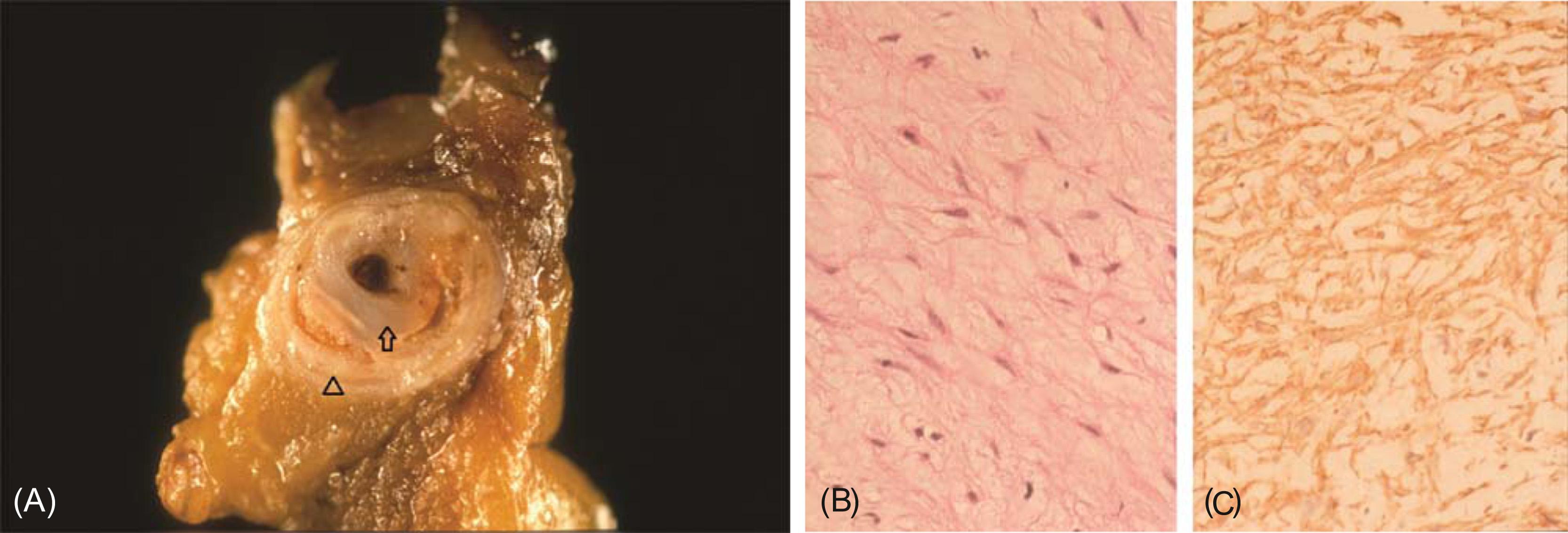 Figure 18.5, Restenosis after balloon angioplasty. (A) ( Left panel ) Gross photograph, demonstrating residual atherosclerotic plaque ( arrowhead ) and a new, glistening proliferative lesion ( arrow ). (B and C) Proliferative tissue causing occlusive restenosis several months after coronary balloon angioplasty and obtained by atherectomy. (B) ( Middle panel ) General morphology of the stellate mesenchymal cells haphazardly arranged in abundant loose myxoid matrix. (C) ( Right panel ) Positive immunoperoxidase staining for α-smooth muscle cell actin demonstrating that these cells possess a smooth muscle cell phenotype [(B) H&E stain; (C) immunoperoxidase stain].