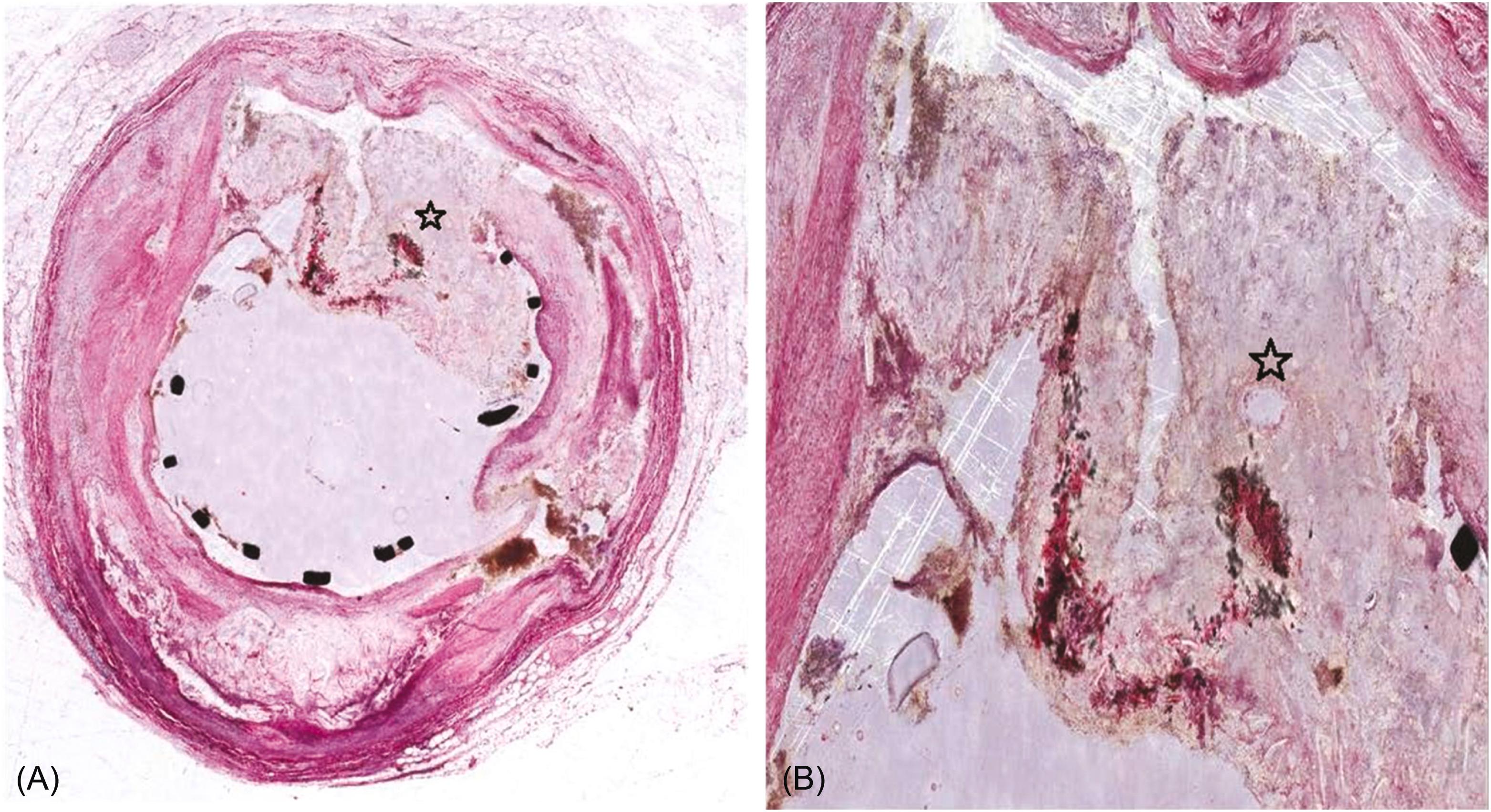 Figure 18.6, Coronary artery acute coronary plaque rupture and drug-eluting (paclitaxel) coronary stent in place. (A) ( Left panel ) Coronary artery with struts of the stent in place. (B) ( Right panel ) The site of plaque rupture is shown at higher magnification. Note the plaque contents ( asterisk ) exposed to the lumen. A specialized technique was used to prepare the specimen shown in this figure and Fig. 14.7B .