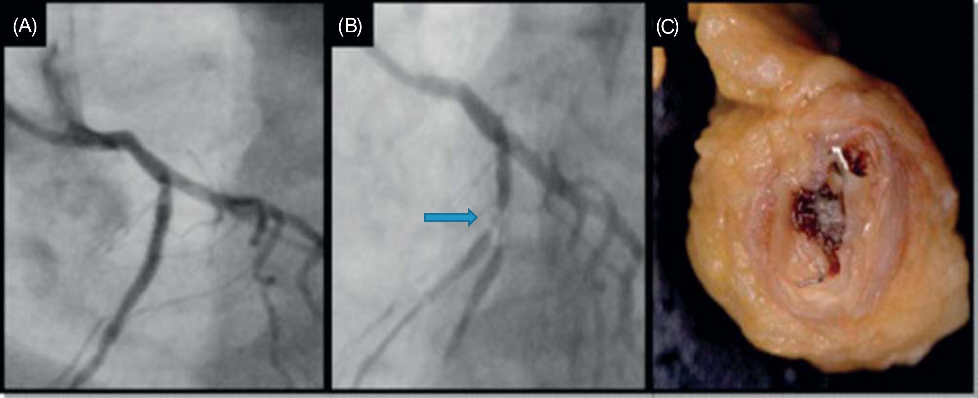 Figure 18.8, (A) Drug-eluting stent implantation in the proximal left anterior descending artery, complicated by (B) stent thrombosis occurring 7 months later, shortly after discontinuation of dual antiplatelet therapy ( arrow ). (C) Gross pathology example of stent thrombosis.