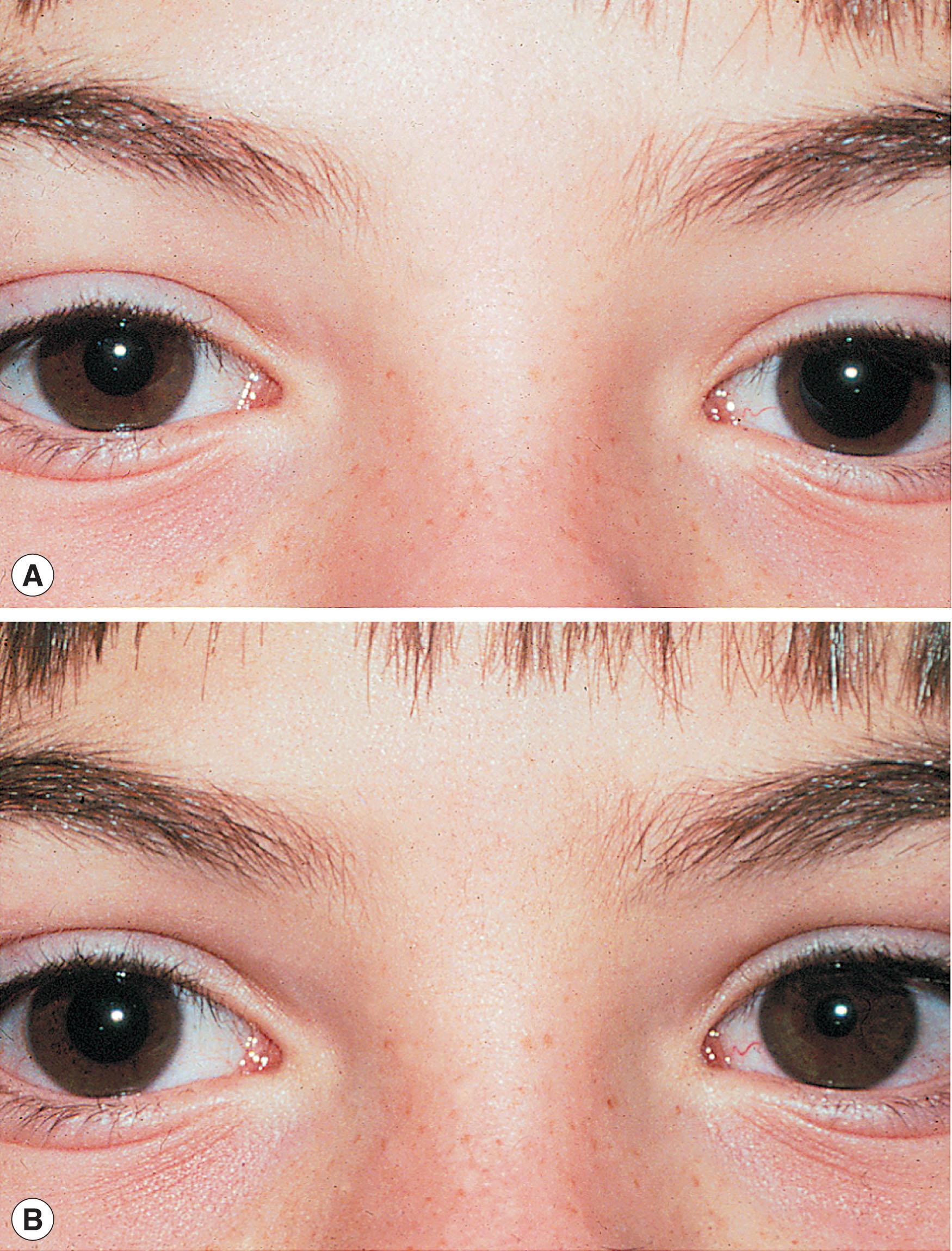 Fig. 52.3, Left Adie pupil (A) before and (B) after instillation of 0.1% pilocarpine. The right pupil is unchanged while the left constricts due to denervation hypersensitivity.