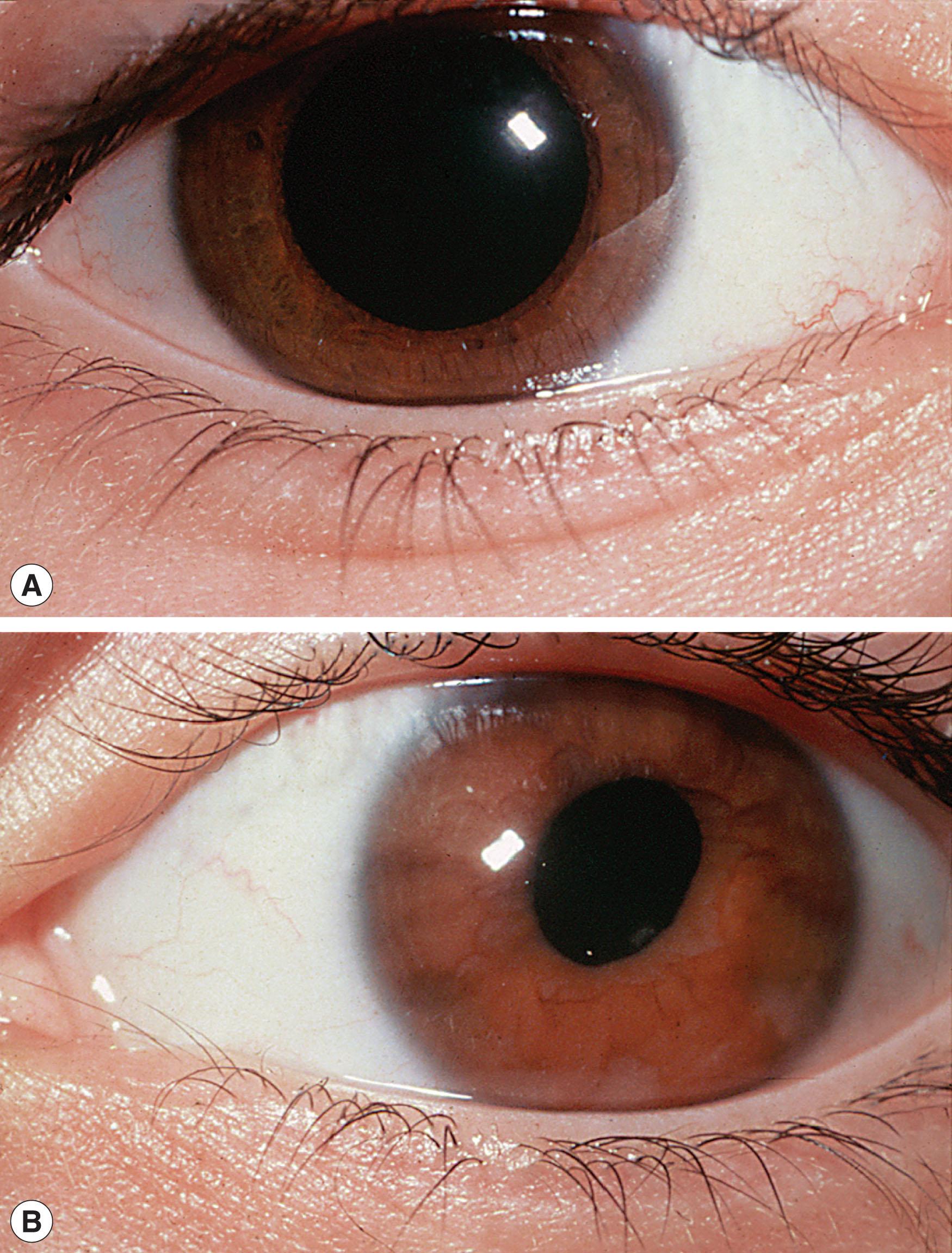 Fig. 52.4, Normal right eye (A) and left iris abnormality with sluggish reactions and small pupil due to leukemic infiltration (B).