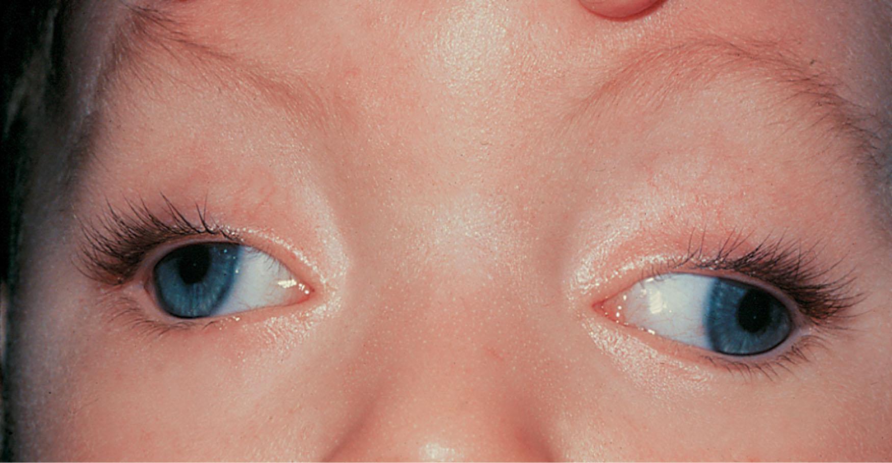 Fig. 52.5, Bilateral congenital third nerve palsy with fixed and unreactive pupils.