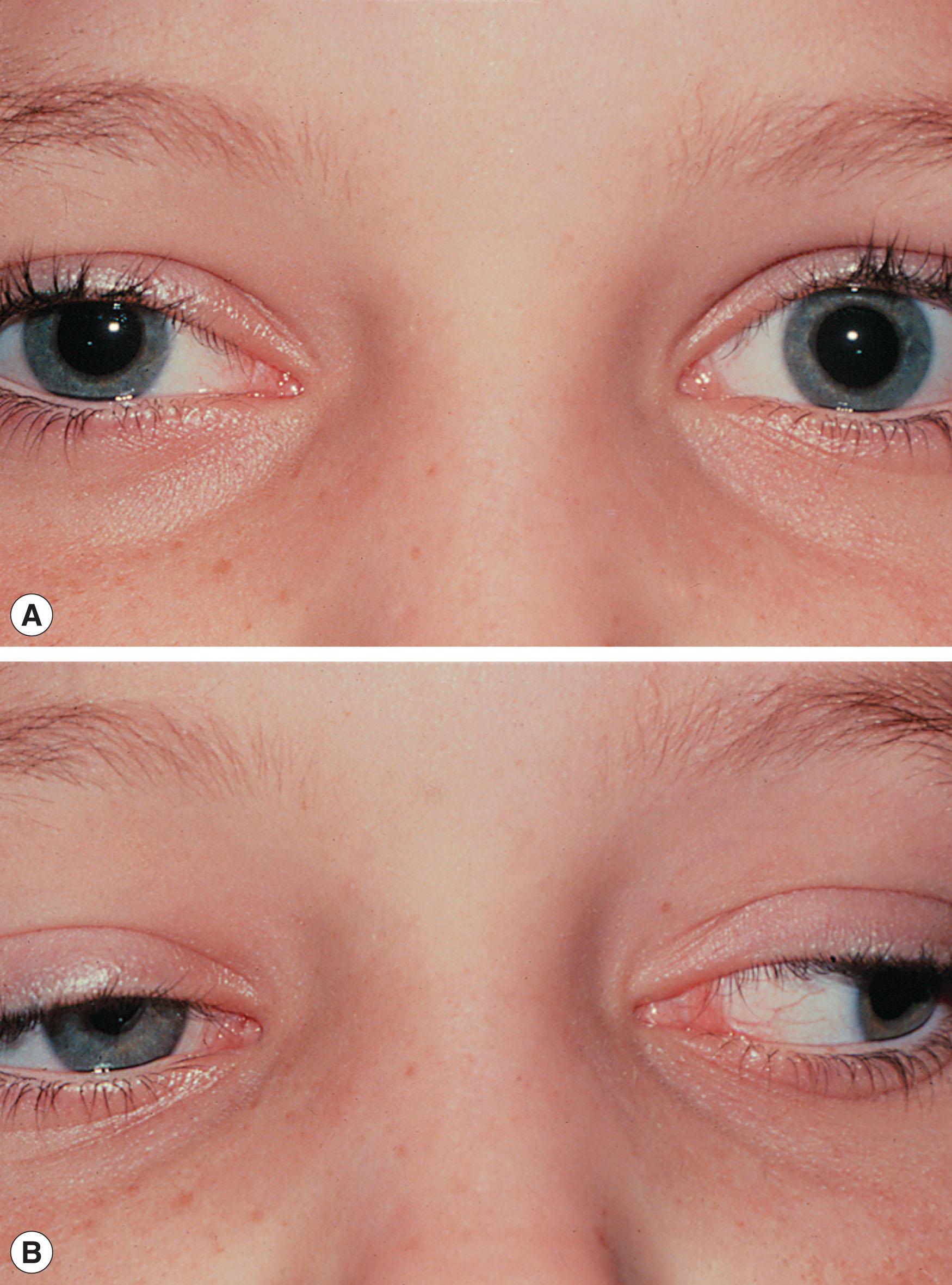 Fig. 52.6, Aberrant regeneration following partial recovery from right traumatic third nerve palsy. The right pupil constricts on attempted adduction.