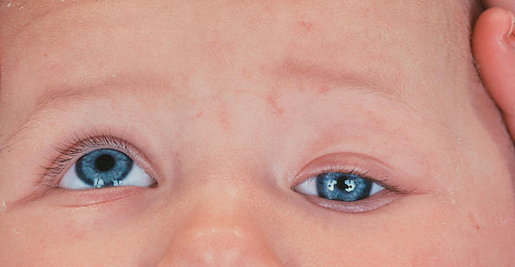 Fig. 52.7, Left congenital third nerve palsy. In longstanding cases the pupil may be small.