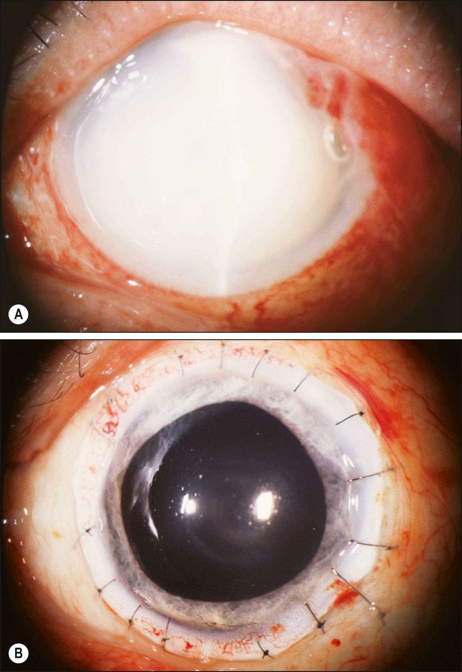 Fig. 141.1, Therapeutic keratoplasty for bacterial infection.