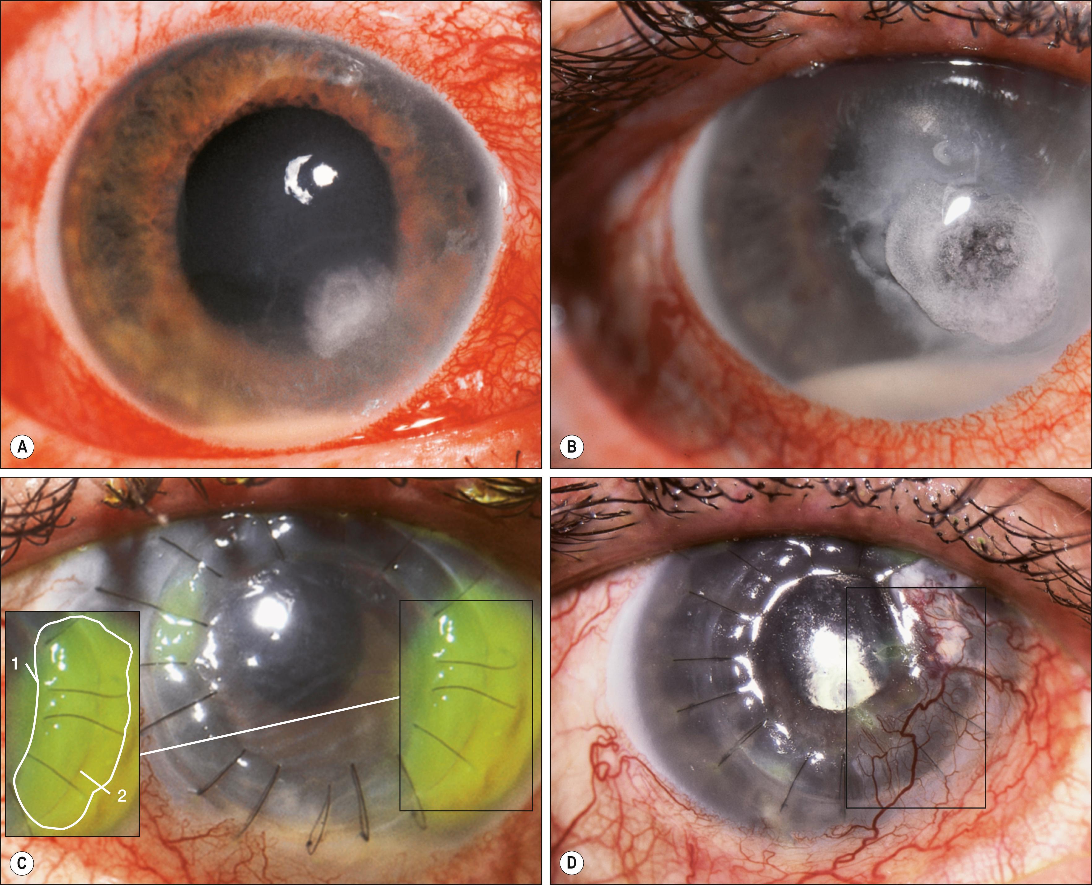 Fig. 141.2, Therapeutic keratoplasty for herpetic keratitis.