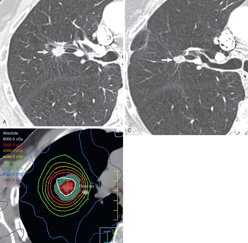 Fig. 66.1, Stereotactic body radiotherapy (SBRT) in a woman with lung adenocarcinoma receiving definitive radiation therapy because of poor performance status. (A) CT image obtained before treatment shows a spiculated right upper lobe nodule (arrow). (B) Computed dosimetric axial reconstruction obtained for radiation treatment plan shows the tumor delineated by red color and the green target. The white line surrounding the tumor defines the area that will receive the highest radiation dose, 6000 cGy in this case. Each isodose line farther away from the tumor demarcates an area that will receive a progressively smaller radiation dose. (C) CT image obtained 16 months after treatment shows decrease in size of radiated primary lung malignancy (arrow). In addition, there are subtle opacities within the radiation treatment field corresponding to radiation-induced lung disease. Note how precise target delineation minimizes radiation doses and damage to surrounding tissues.