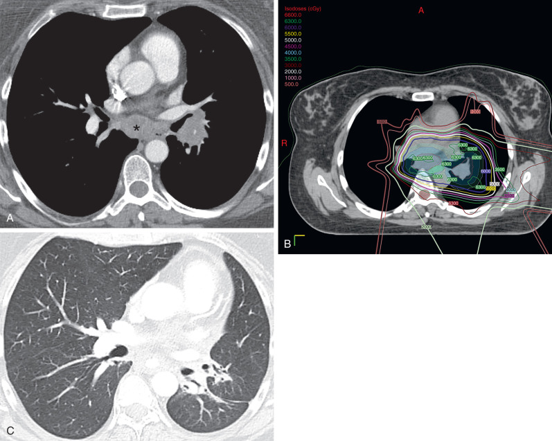 Fig. 66.2, Proton radiation in a woman with lung adenocarcinoma. (A) CT image obtained before treatment shows a left lower lobe mass extending to the left hilar region and subcarinal nodal metastasis (asterisk) . (B) Computed dosimetric axial reconstruction obtained for proton radiation plan shows primary lung malignancy and nodal metastatic disease receiving maximal isodose (6600 cGY). (C) CT image obtained 3 years after radiation therapy shows focal lung opacities confined to treatment field and normal adjacent lung.