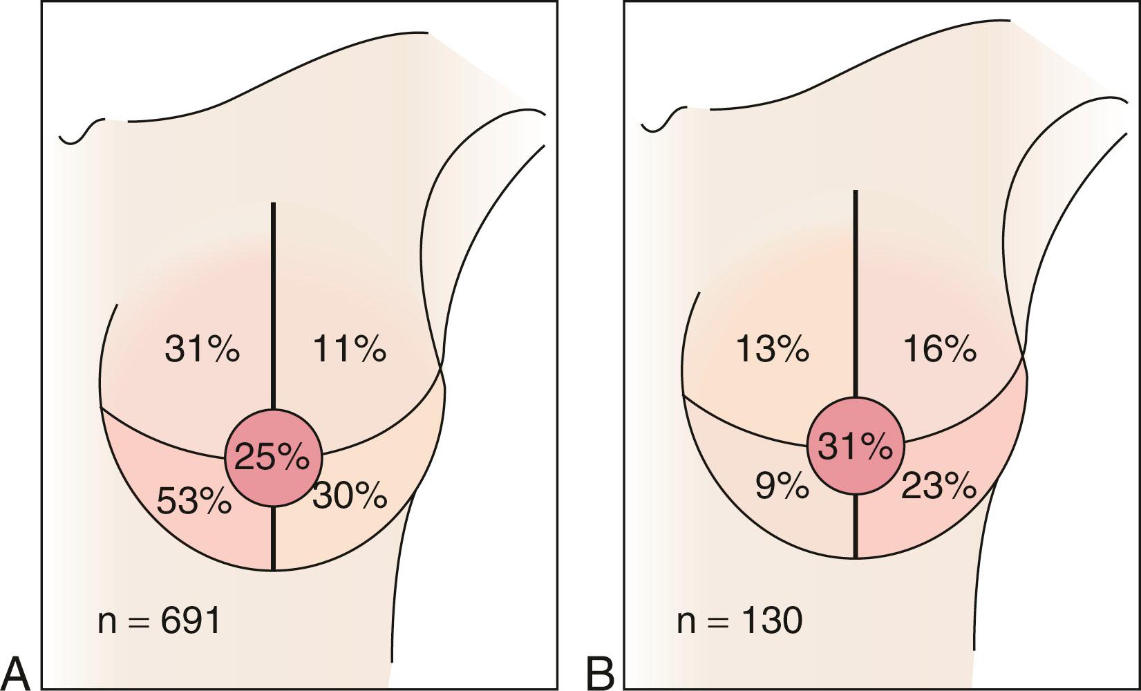 Fig. 35.2, Location of the primary tumor in patients with a positive internal mammary chain sentinel node. Breast cancers located in the lateral quadrants can drain to the internal mammary nodes. (A) Most breast cancers that drain to the internal mammary nodes are located in the medial aspect of the breast. (B) Most patients with positive internal mammary nodes, however, will have a lesion in the lateral aspect of the breast.