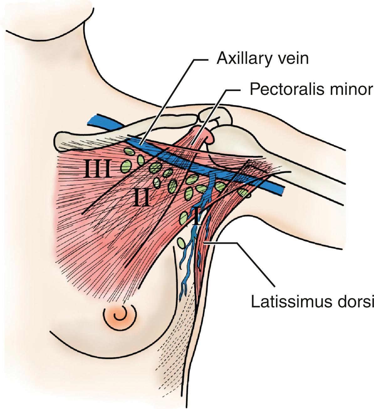 Fig. 35.3, Anatomy of the axilla. The axillary triangle is defined by the axillary vein, the latissimus dorsi muscle, and the chest wall. The level I lymph nodes are inferior and lateral to the pectoralis minor, the level II lymph nodes are behind the pectoralis minor and below the axillary vein, and the level III lymph nodes are medial to the pectoralis minor and below the axillary vein.