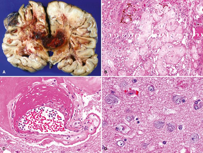 Fig. 21.2, Radiation necrosis (A), vasculopathy (B, C), and neurodegenerative changes (D). (A) Radiation necrosis. Extensive, predominantly white matter necrosis and hemorrhage on gross pathology. (B) Radiation vasculopathy. Extensive vascular hyalinization and hemosiderin accumulation from focal microhemorrhage. (C) Radiation vasculopathy. Noninflammatory fibrinoid vascular necrosis. (D) Radiation-associated neurodegenerative changes. Abundant neurofibrillary tangles were seen in neurons from this area of radiation-damaged cortex.