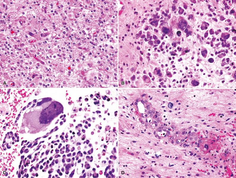 Fig. 21.3, Oligodendroglioma on initial (A) and postradiation (B–D) biopsies. (A) Oligodendroglioma before therapy. Classic features of oligodendroglioma. This case also had 1p and 19q deletions. (B) Radiation atypia. Postradiation biopsy of same tumor shows radiation atypia in tumor cells, imparting a more astrocytoma-like morphology. (C) Radiation atypia. Scattered large, bizarre tumor cells with abundant cytoplasm and foamy appearance. (D) Radiation atypia. Radiation atypia in endothelial cells mimicking microvascular proliferation.