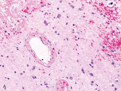 Fig. 21.4, Scattered residual glioma cells identified in region of marked therapy effects from IDH-mutant astrocytoma patient previously treated with radiation. (A) On routine H & E stain, there is vascular hyalinization and fibrinoid necrosis, accompanied by hypocellularity, tissue rarefaction, and only rare atypical nuclei. (B) Evenly spaced, stellate-appearing astrocytes are noted on GFAP stain, consistent with reactive gliosis. (C, D) However, IDH1 R132H (C) and MAP2 (D) immunostains highlight scattered residual/recurrent glioma cells, some of which resemble reactive astrocytes.