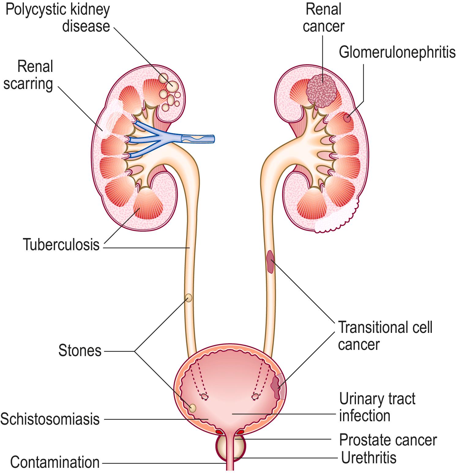 Fig. 12.5, Principal sources of haematuria.