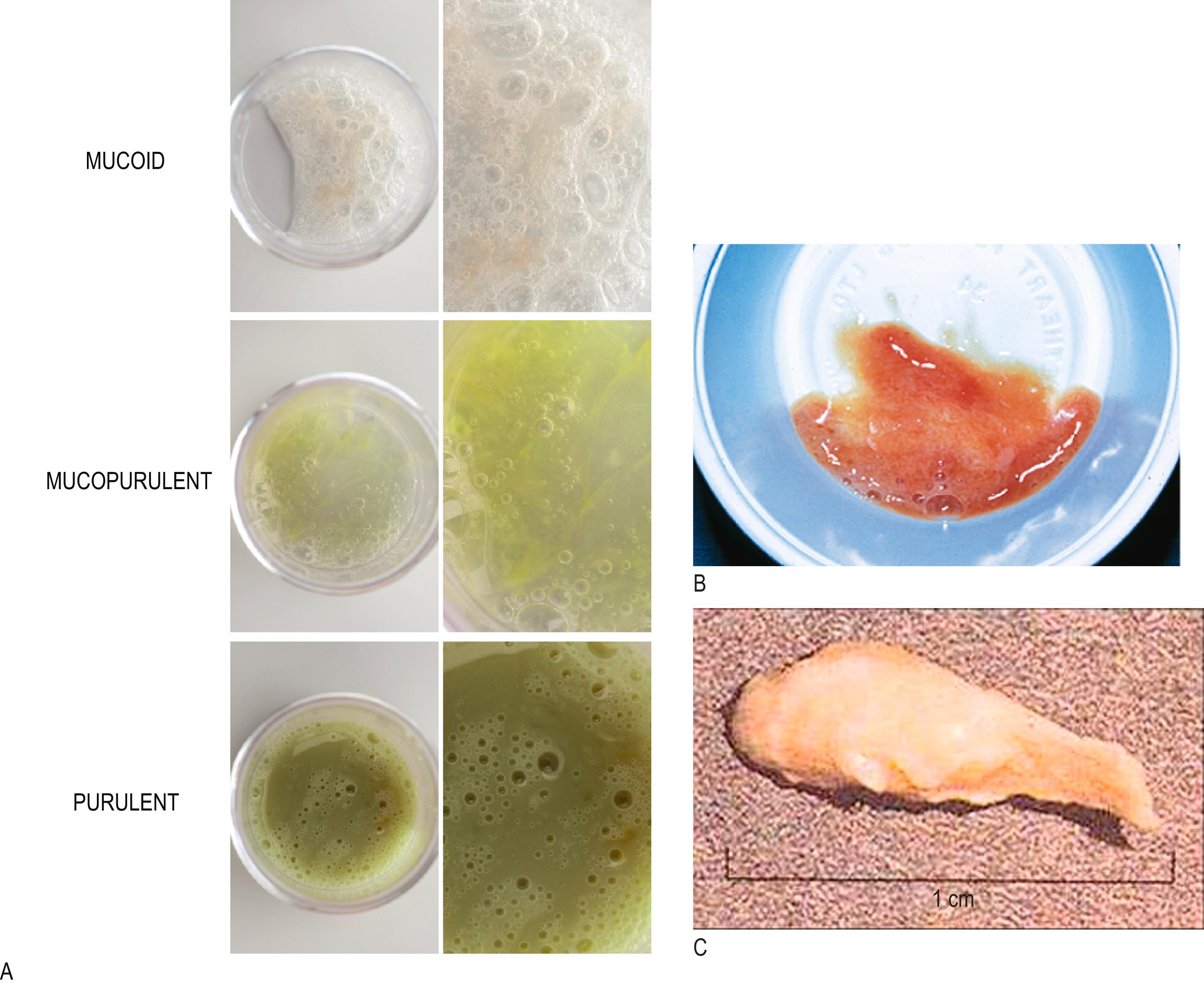 Fig. 5.3, Sputum appearance in disease. A Colour chart of sputum purulence used in bronchiectasis. B Rusty red sputum of pneumococcal pneumonia. C Mucus plug from a patient with asthma.