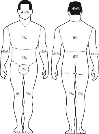 Fig. 78.1, Estimate of %TBSA: “rule of nines.”