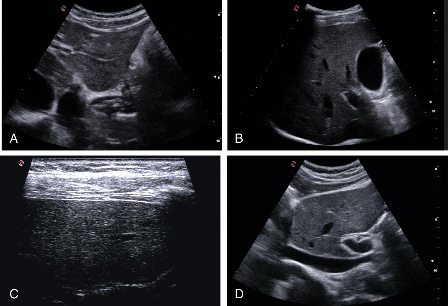 Fig. 8.1, Normal looking liver. (A) Sharp margin. (B) Smooth surface and homogeneous echotexture. (C) Smooth surface assessed with high-frequency transducer. (D) Normal-sized caudate lobe.