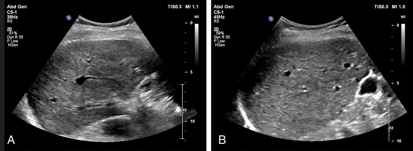 Fig. 8.2, Liver with ultrasound features of advanced chronic disease/cirrhosis. (A) Heterogeneous parenchyma echotexture. (B) Coarse echotexture and posterior nodular surface. (C) Grossly heterogeneous parenchyma echotexture, nodular surface. (D) Echocoarse pattern, anterior and posterior nodular surface, caudate hypertrophy. (E) Heterogeneous echotexture, hepatomegaly, and caudate hypertrophy. (F) Shrunken right lobe with nodular surface and perihepatic ascites. (G) Nodular surface and rounded margin assessed with high-frequency transducer. (H) Nodular surface and perihepatic ascites assessed with high-frequency transducer.