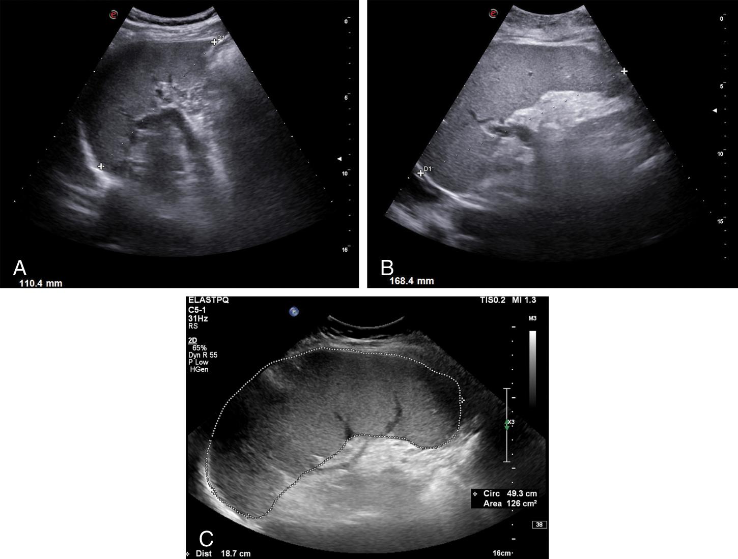 Fig. 8.3, (A) Spleen of normal size. (B) Splenomegaly (bipolar length). (C) Splenomegaly (bipolar length and area).