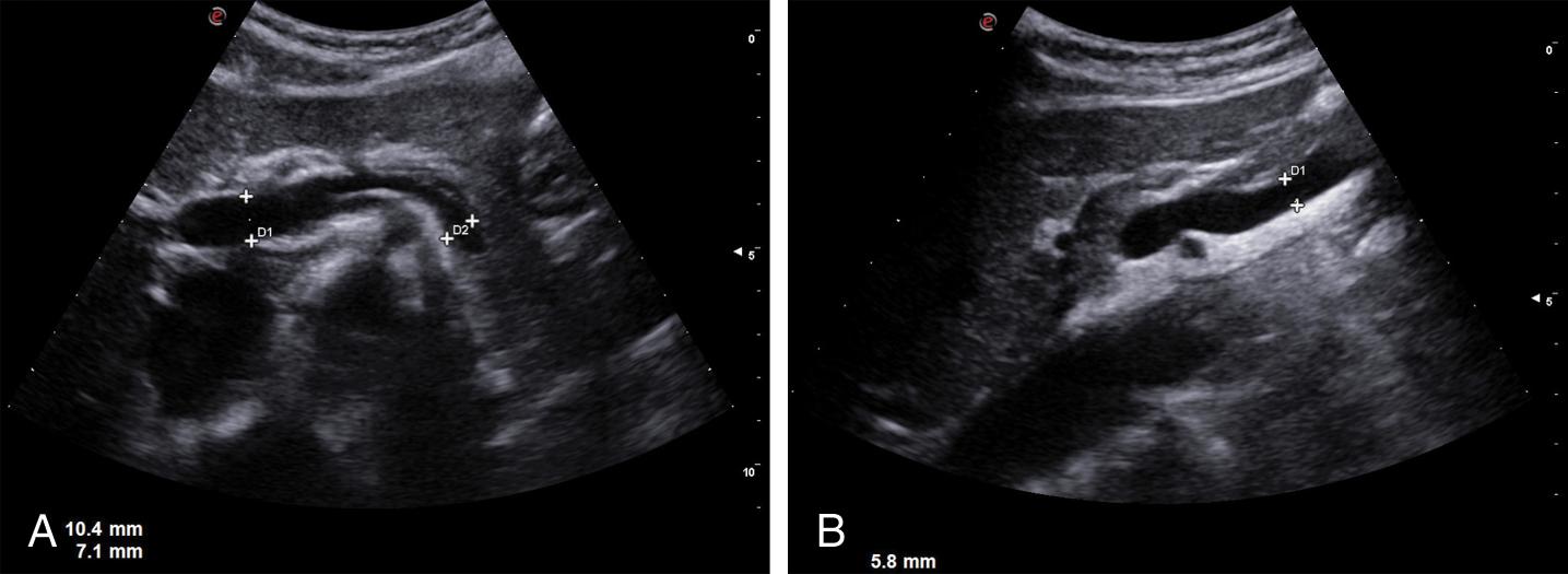 Fig. 8.5, (A) Normal appearance of portal vein and splenic vein. (B) Normal appearance of superior mesenteric vein. (C) Portal vein dilation in liver cirrhosis. (D) Portal vein and splenic vein dilation in liver cirrhosis. (E) Portal vein dilation in idiopathic portal hypertension.