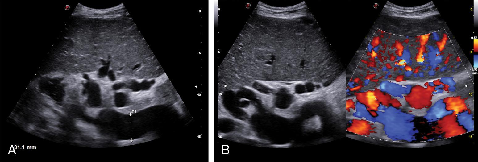 Fig. 8.6, (A) Splenic vein dilation, collaterals at the splenic hilum (B-mode ultrasound), and Gamna-Gandy bodies in the splenic parenchyma. (B) Splenic vein dilation and collaterals at the splenic hilum (B-mode and color-Doppler ultrasound). (C) Collaterals at the inferior pole of the spleen. (D) Epigastric collaterals (collaterals of the gastric vein). (E) Paraumbilical vein recanalization.