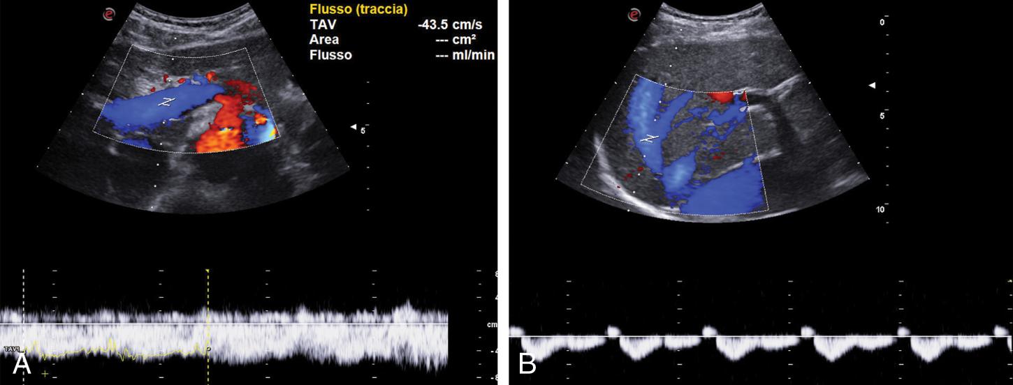 Fig. 8.7, (A) Hepatopetal blood flow with normal flow velocity in the portal vein. (B) Normal triphasic blood flow in the right hepatic vein.