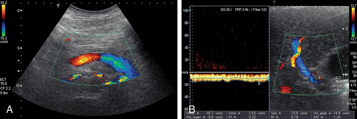 Fig. 8.8, (A) Hepatofugal blood flow in the splenic vein. (B) Hepatofugal blood flow in the right intrahepatic portal branch.