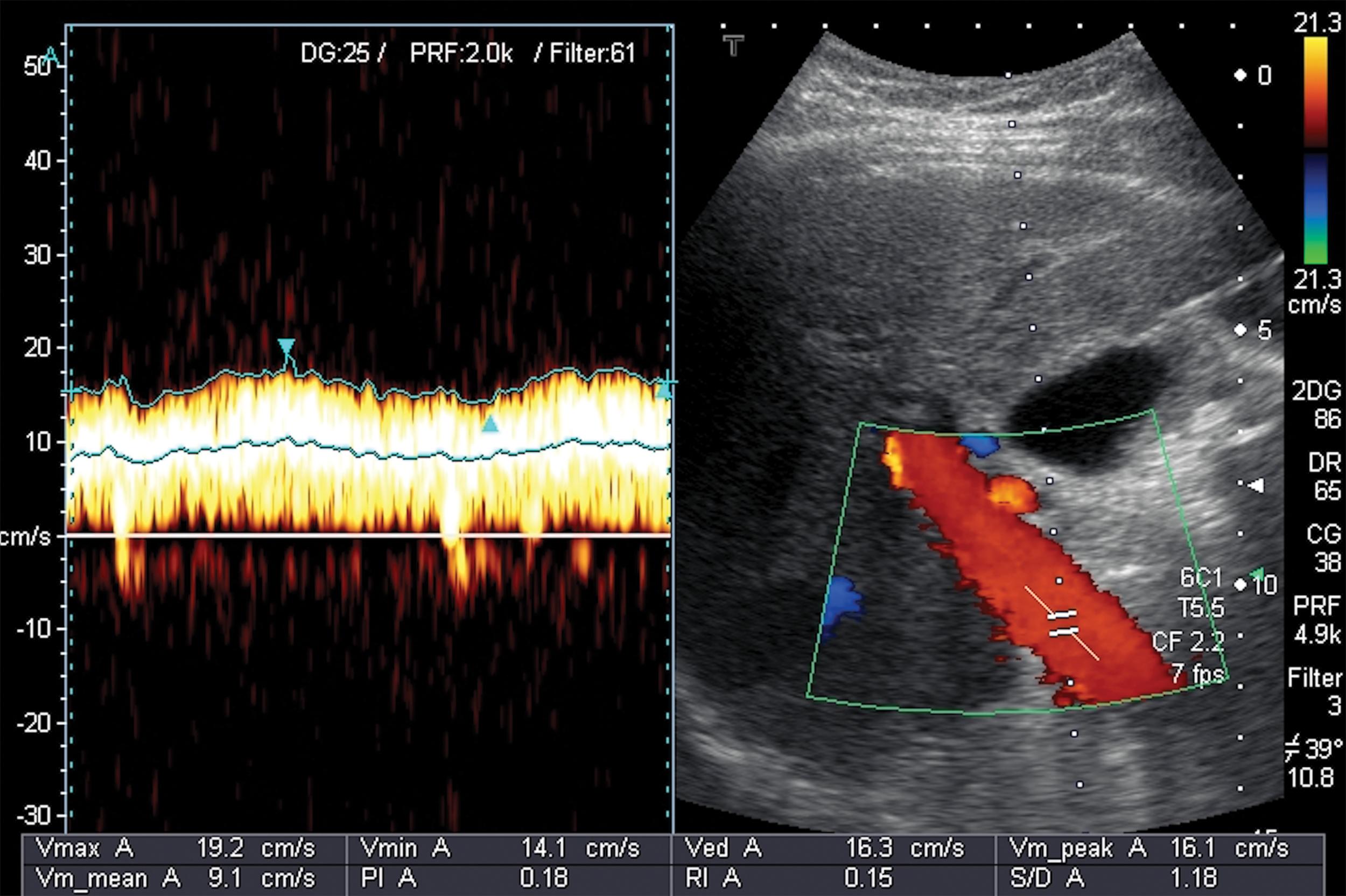 Fig. 8.9, Slow hepatopetal portal blood flow.