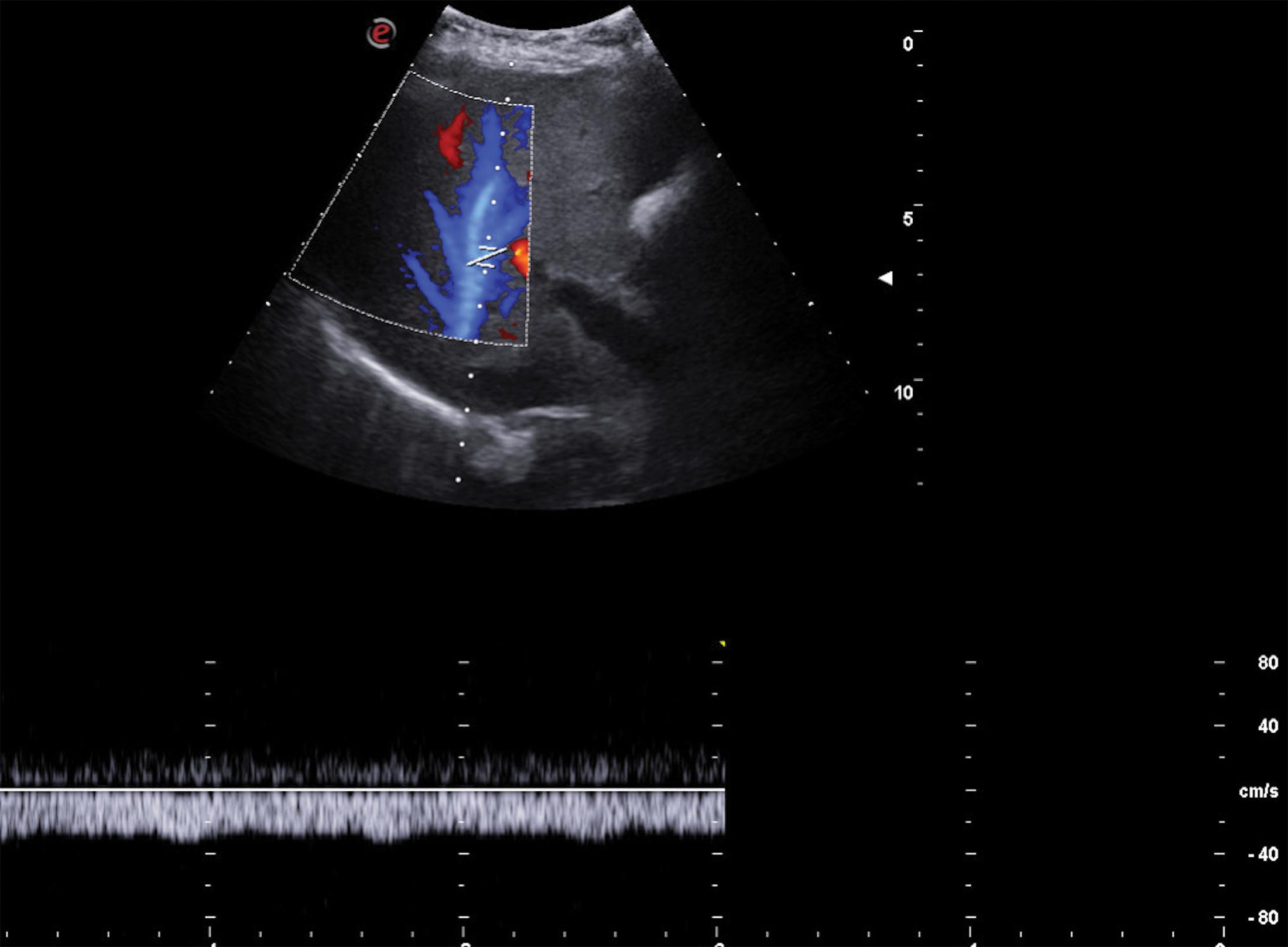 Fig. 8.10, Monophasic blood flow in the right hepatic vein.