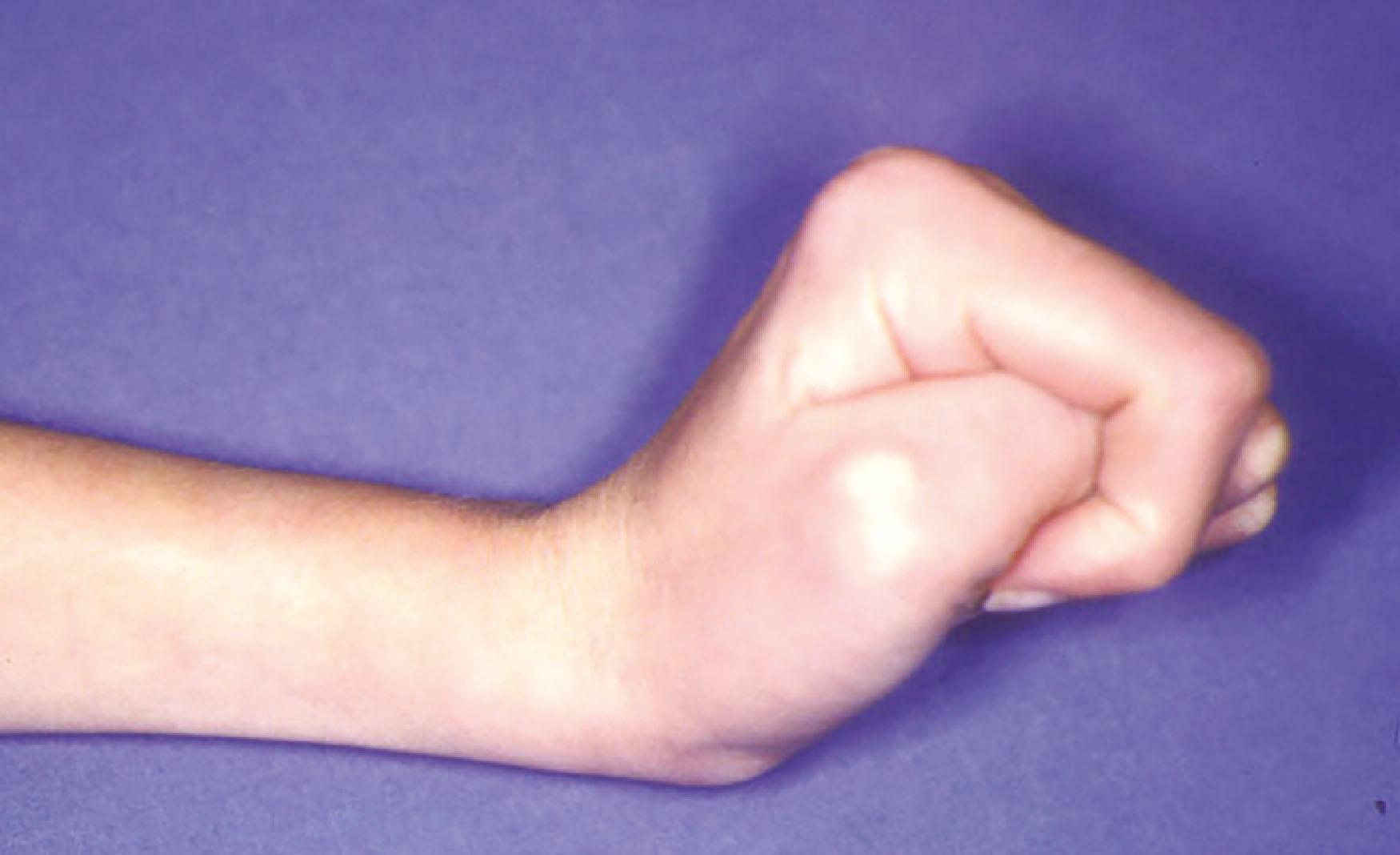 Figure 29.4, Spastic adducted thumb: the “thumb in palm” deformity.