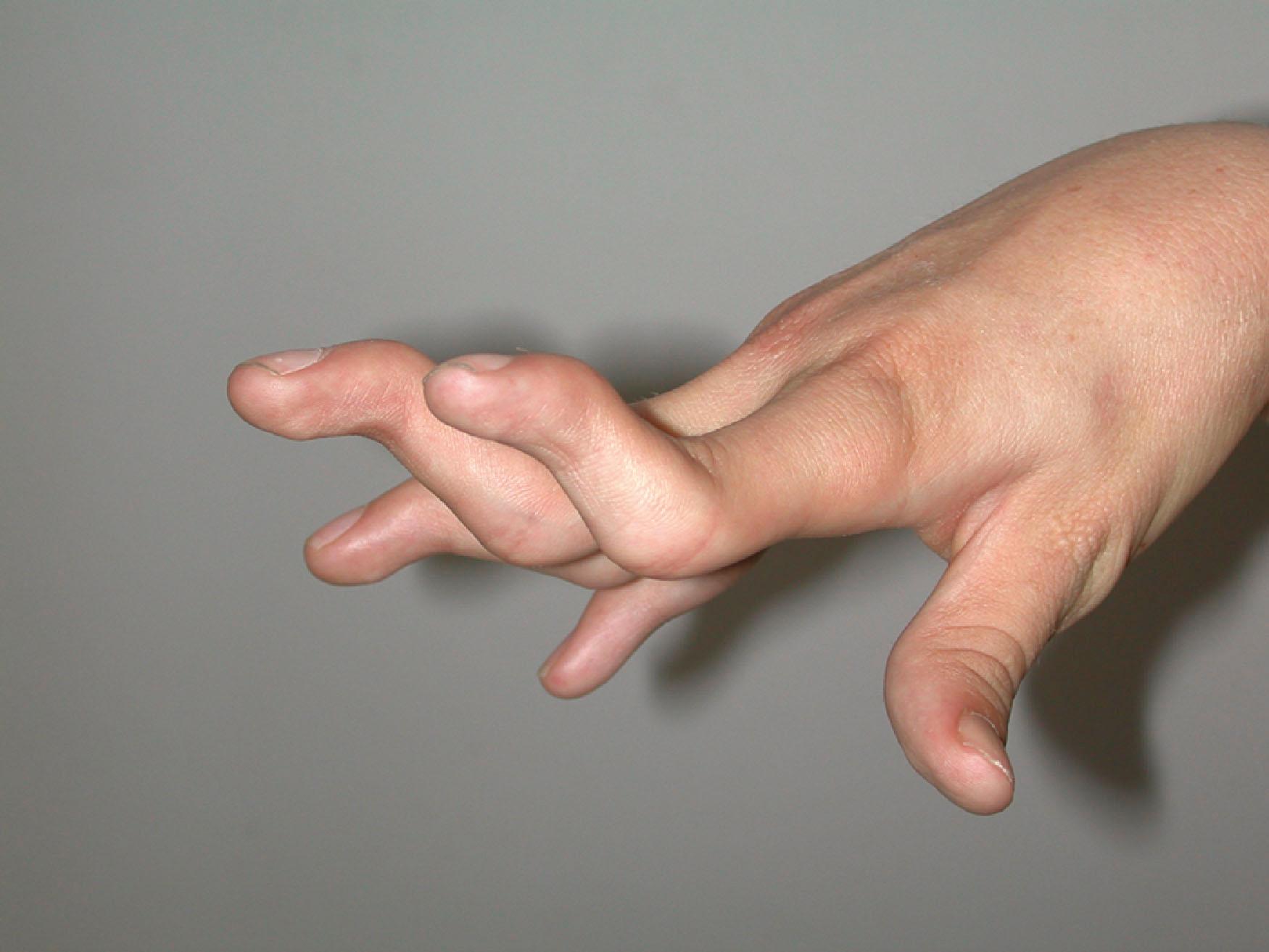 Figure 29.6, Spastic swan-neck deformity of the fingers.